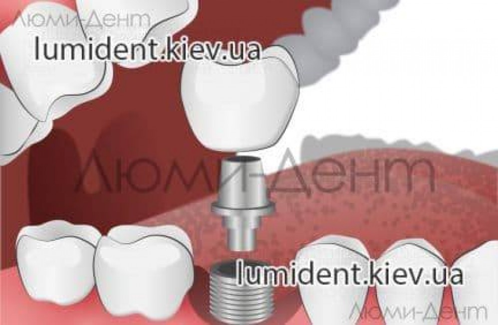 implantatsija-zubov.jpg